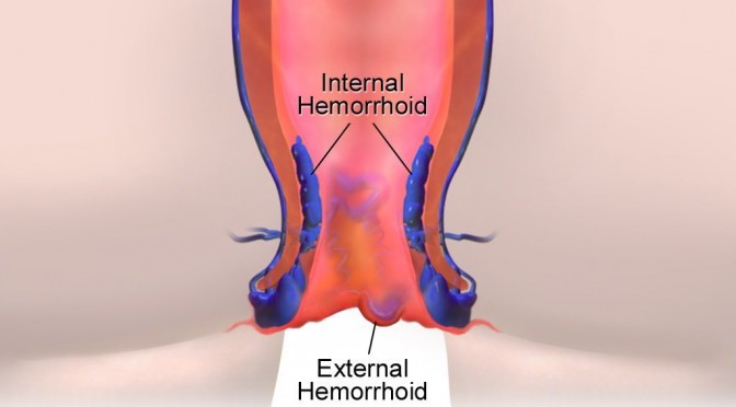 Ayurvedic Medicine For Piles