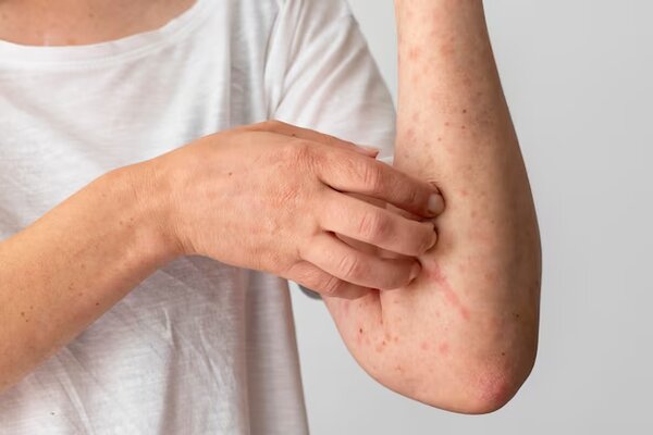 What is Eczema? Its Symptoms and How To Treat It Naturally?