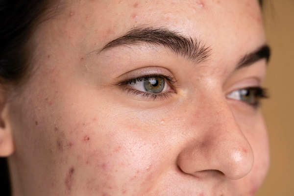 The Best Effective Ayurvedic Herbs for Clearing Acne